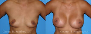 Patient 16a Breast Augmentation Before and After