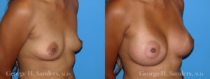 Patient 16b Breast Augmentation Before and After