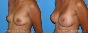 Patient 16c Breast Augmentation Before and After