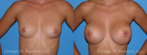 Patient 17a Breast Augmentation Before and After