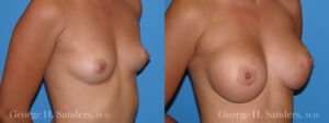 Patient 17b Breast Augmentation Before and After