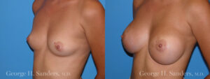 Patient 17c Breast Augmentation Before and After