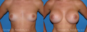 Patient 18a Breast Augmentation Before and After