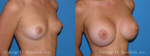 Patient 18b Breast Augmentation Before and After