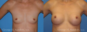 Patient 19a Breast Augmentation Before and After