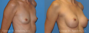 Patient 19b Breast Augmentation Before and After