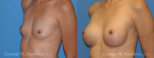 Patient 19c Breast Augmentation Before and After