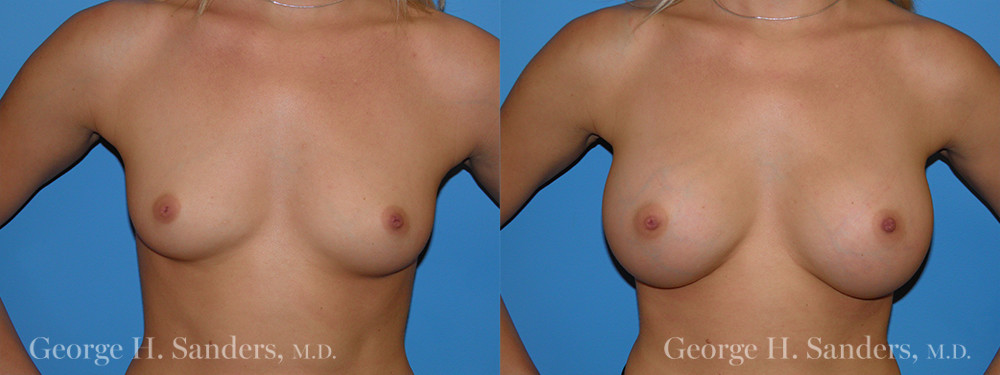 Patient 2a Breast Augmentation Before and After