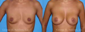 Patient 4a Breast Augmentation Before and After