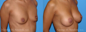 Patient 4c Breast Augmentation Before and After