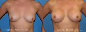 Patient 6a Breast Augmentation Before and After