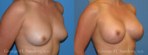 Patient 6b Breast Augmentation Before and After