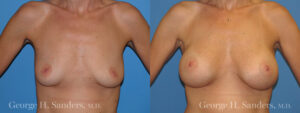 Patient 7a Breast Augmentation Before and After