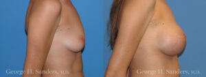 Patient 7b Breast Augmentation Before and After