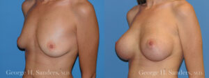 Patient 7c Breast Augmentation Before and After