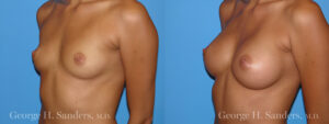 Patient 8b Breast Augmentation Before and After
