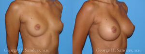 Patient 8c Breast Augmentation Before and After