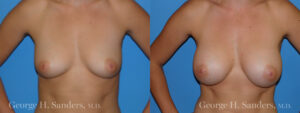 Patient 9a Breast Augmentation Before and After