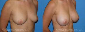 Patient 9b Breast Augmentation Before and After