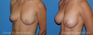 Patient 9c Breast Augmentation Before and After