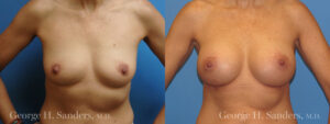 Patient 10a Breast Augmentation Before and After