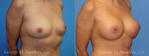 Patient 10c Breast Augmentation Before and After