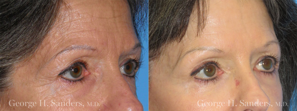 Patient 1b Brow Lift Before and After