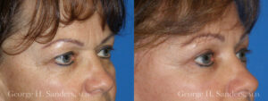 Patient 2a Brow Lift Before and After