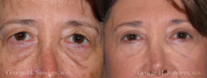 Patient 3a Brow Lift Before and After