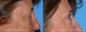 Patient 3b Brow Lift Before and After