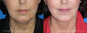 Patient 1c Chin Augmentation Before and After