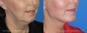 Patient 1b Chin Augmentation Before and After
