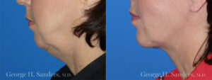 Patient 1a Chin Augmentation Before and After