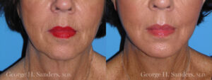 Patient 2b Chin Augmentation Before and After