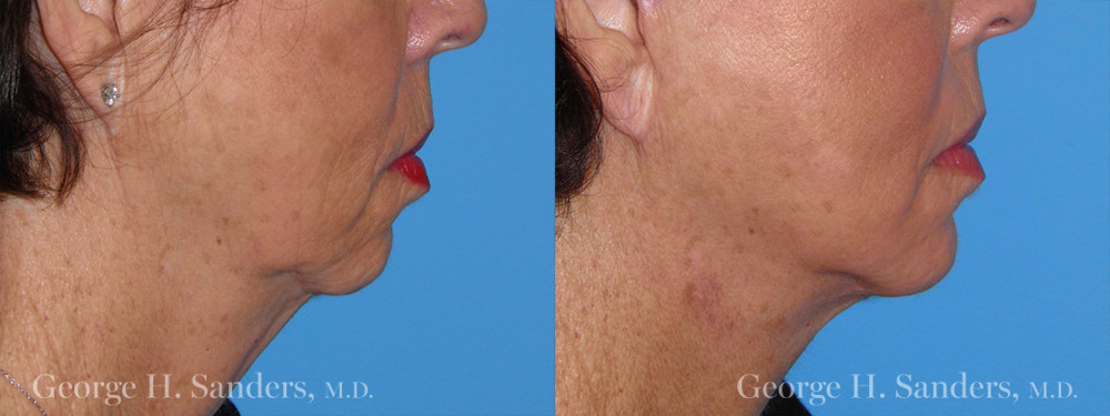 Patient 2a Chin Augmentation Before and After
