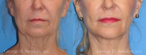 Patient 4c Chin Augmentation Before and After