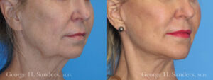 Patient 4b Chin Augmentation Before and After