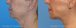Patient 4a Chin Augmentation Before and After