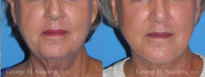 Patient 6c Chin Augmentation Before and After