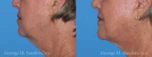 Patient 6a Chin Augmentation Before and After