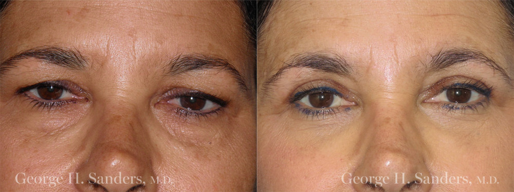 Patient 1a Eyelid Surgery Before and After