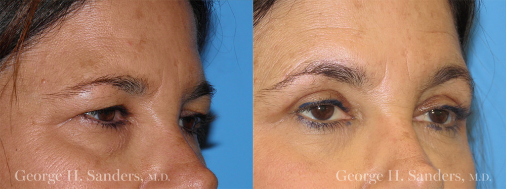 Patient 1b Eyelid Surgery Before and After