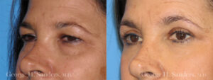 Patient 1c Eyelid Surgery Before and After