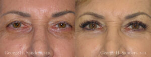 Patient 10a Eyelid Surgery Before and After