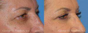 Patient 10b Eyelid Surgery Before and After