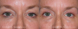 Patient 11a Eyelid Surgery Before and After