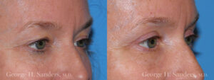 Patient 11b Eyelid Surgery Before and After