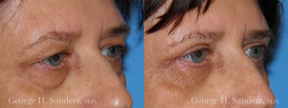 Patient 12b Eyelid Surgery Before and After