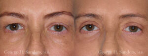 Patient 13a Eyelid Surgery Before and After