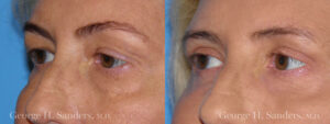 Patient 13b Eyelid Surgery Before and After